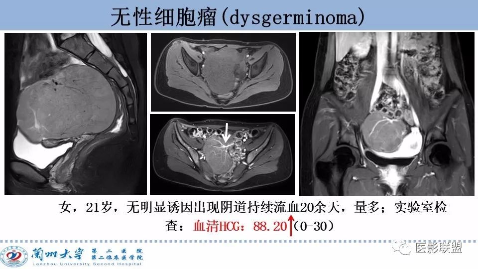 影像PPT - 【PPT】卵巢肿瘤MRI诊断-44