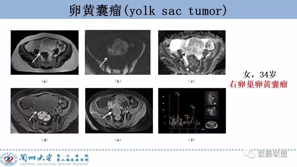 影像PPT - 【PPT】卵巢肿瘤MRI诊断-48