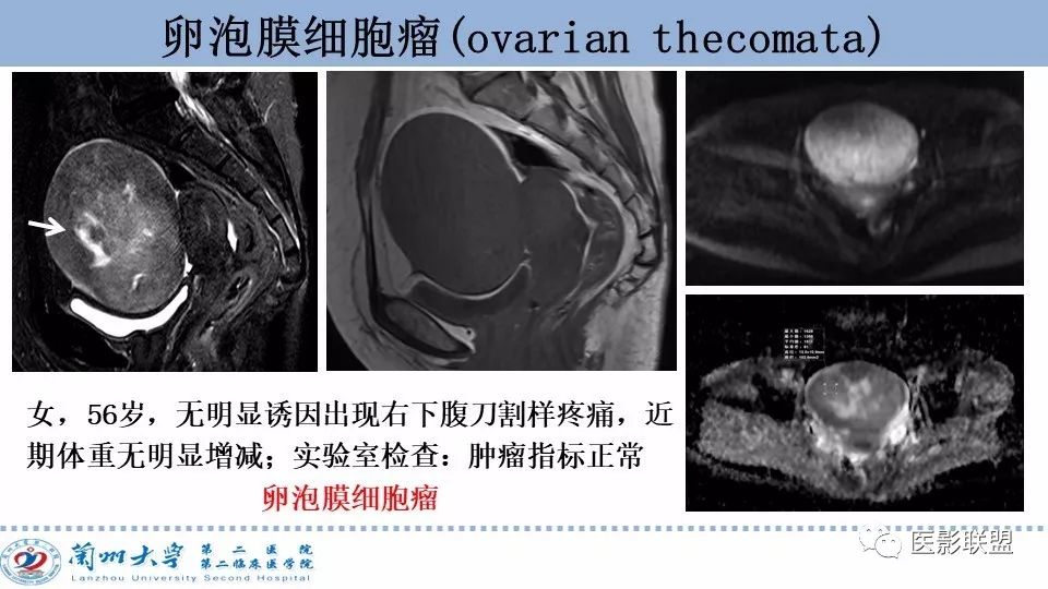 影像PPT - 【PPT】卵巢肿瘤MRI诊断-50