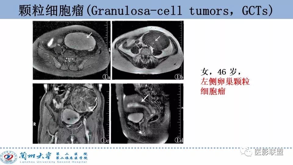 影像PPT - 【PPT】卵巢肿瘤MRI诊断-52