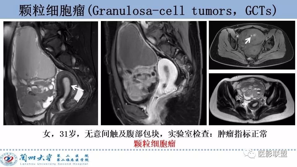 影像PPT - 【PPT】卵巢肿瘤MRI诊断-53