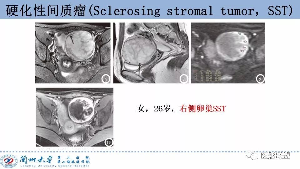 影像PPT - 【PPT】卵巢肿瘤MRI诊断-61