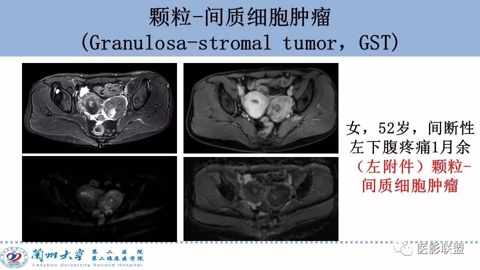 影像PPT - 【PPT】卵巢肿瘤MRI诊断-62