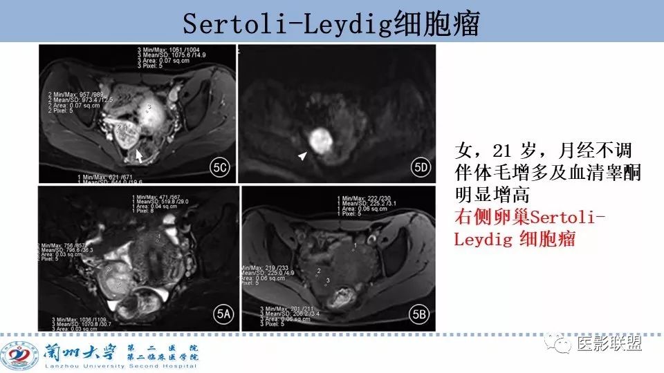 影像PPT - 【PPT】卵巢肿瘤MRI诊断-65