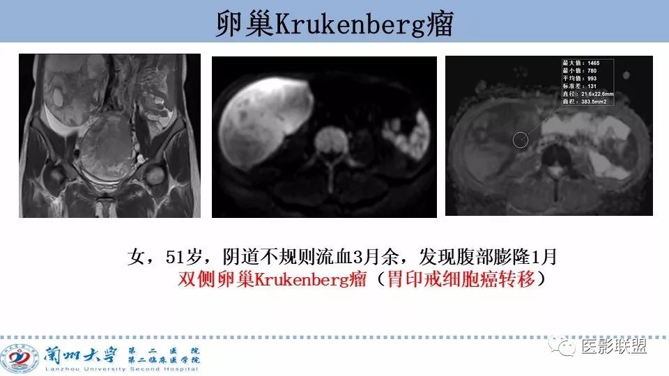 影像PPT - 【PPT】卵巢肿瘤MRI诊断-66