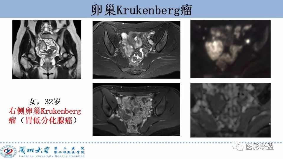 影像PPT - 【PPT】卵巢肿瘤MRI诊断-67