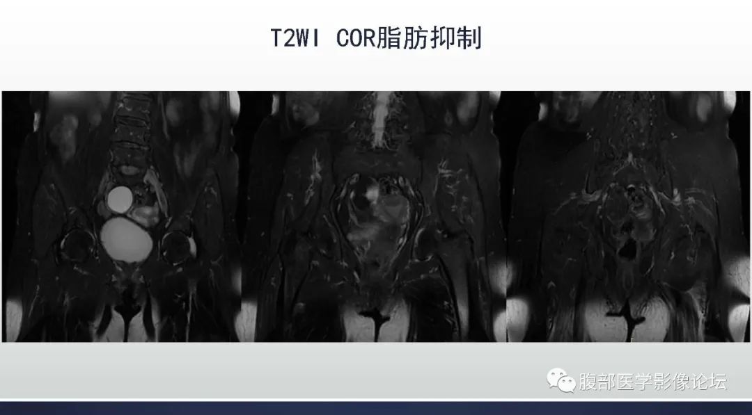 影像PPT - 【病例】卵巢Brenner瘤1例MR影像-5 影像PPT - 【病例】卵巢Brenner瘤1例MR影像-5