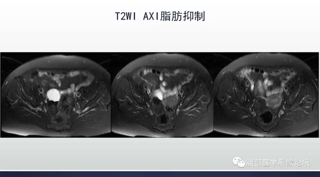 影像PPT - 【病例】卵巢Brenner瘤1例MR影像-7 影像PPT - 【病例】卵巢Brenner瘤1例MR影像-7