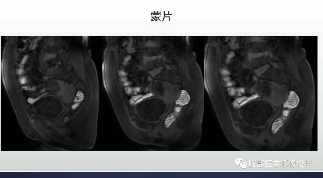 影像PPT - 【病例】卵巢Brenner瘤1例MR影像-10 影像PPT - 【病例】卵巢Brenner瘤1例MR影像-10