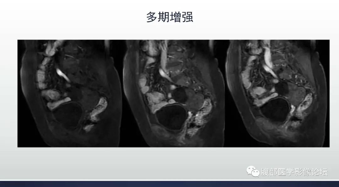 影像PPT - 【病例】卵巢Brenner瘤1例MR影像-11 影像PPT - 【病例】卵巢Brenner瘤1例MR影像-11