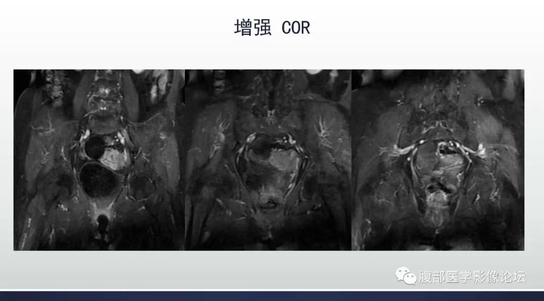 影像PPT - 【病例】卵巢Brenner瘤1例MR影像-12 影像PPT - 【病例】卵巢Brenner瘤1例MR影像-12