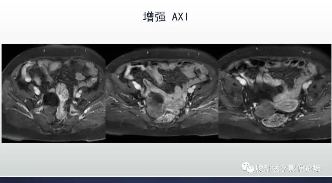 影像PPT - 【病例】卵巢Brenner瘤1例MR影像-13 影像PPT - 【病例】卵巢Brenner瘤1例MR影像-13