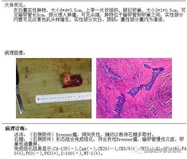 影像PPT - 【病例】卵巢Brenner瘤1例MR影像-15 影像PPT - 【病例】卵巢Brenner瘤1例MR影像-15