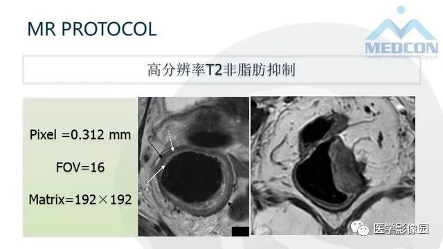 影像PPT - 【PPT】直肠癌MR影像报告书写-5
