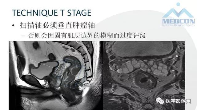 影像PPT - 【PPT】直肠癌MR影像报告书写-6