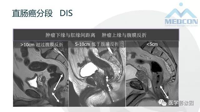影像PPT - 【PPT】直肠癌MR影像报告书写-8