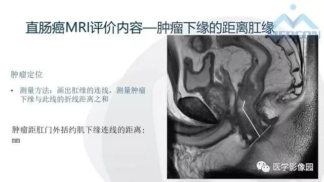影像PPT - 【PPT】直肠癌MR影像报告书写-9