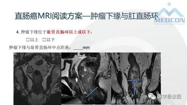 影像PPT - 【PPT】直肠癌MR影像报告书写-10