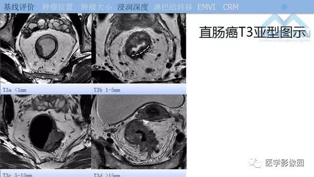 影像PPT - 【PPT】直肠癌MR影像报告书写-16