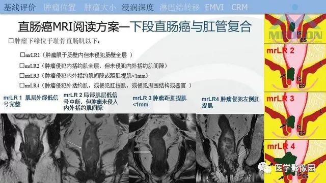 影像PPT - 【PPT】直肠癌MR影像报告书写-17