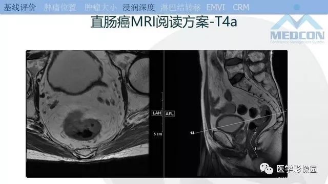影像PPT - 【PPT】直肠癌MR影像报告书写-18