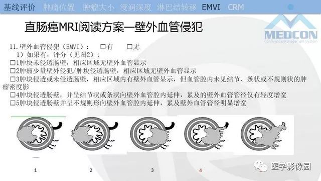 影像PPT - 【PPT】直肠癌MR影像报告书写-21