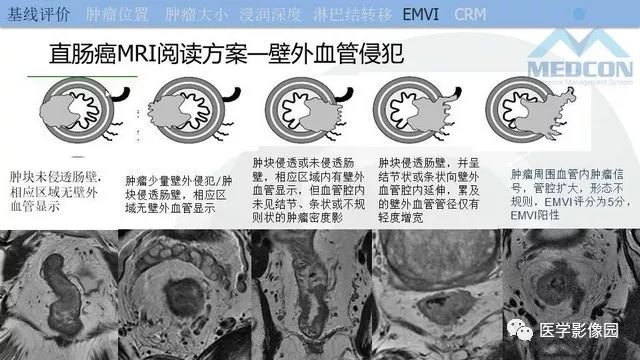 影像PPT - 【PPT】直肠癌MR影像报告书写-22