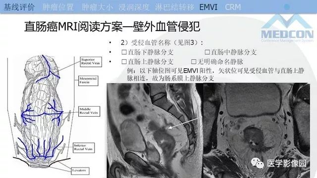 影像PPT - 【PPT】直肠癌MR影像报告书写-23