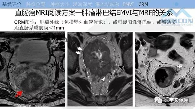 影像PPT - 【PPT】直肠癌MR影像报告书写-25