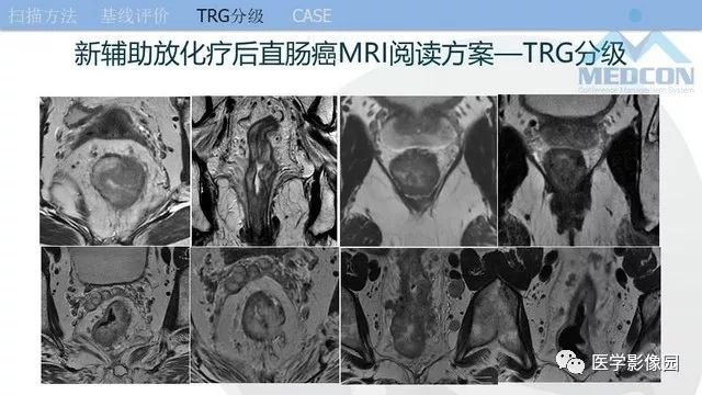 影像PPT - 【PPT】直肠癌MR影像报告书写-28