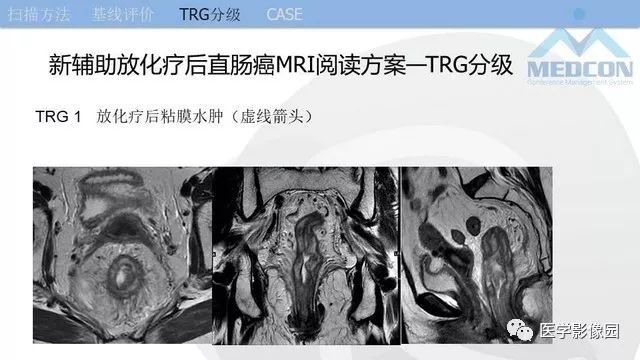 影像PPT - 【PPT】直肠癌MR影像报告书写-29