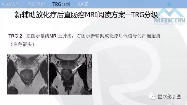 影像PPT - 【PPT】直肠癌MR影像报告书写-30