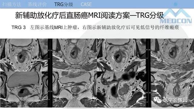 影像PPT - 【PPT】直肠癌MR影像报告书写-31