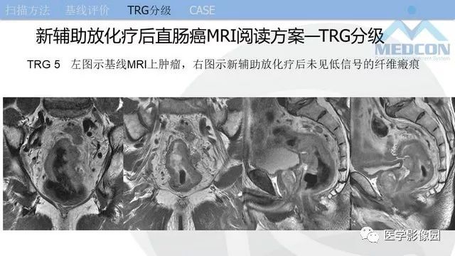 影像PPT - 【PPT】直肠癌MR影像报告书写-32