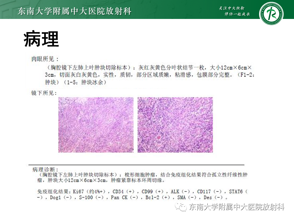 影像PPT - 【病例】胸膜孤立性纤维瘤1例CT影像-3