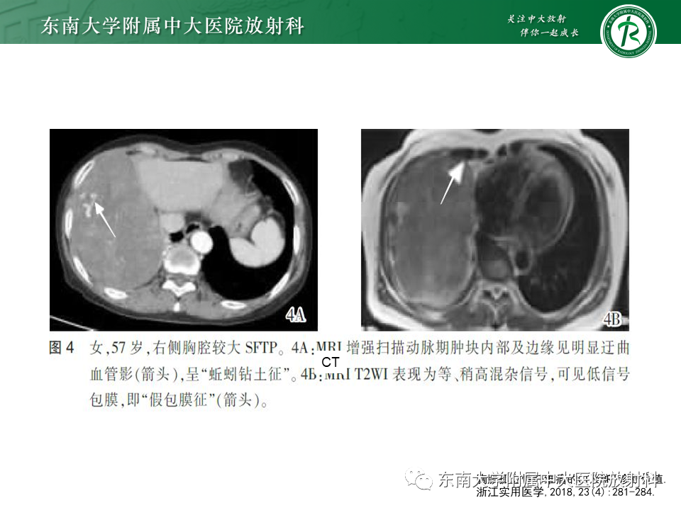 影像PPT - 【病例】胸膜孤立性纤维瘤1例CT影像-12