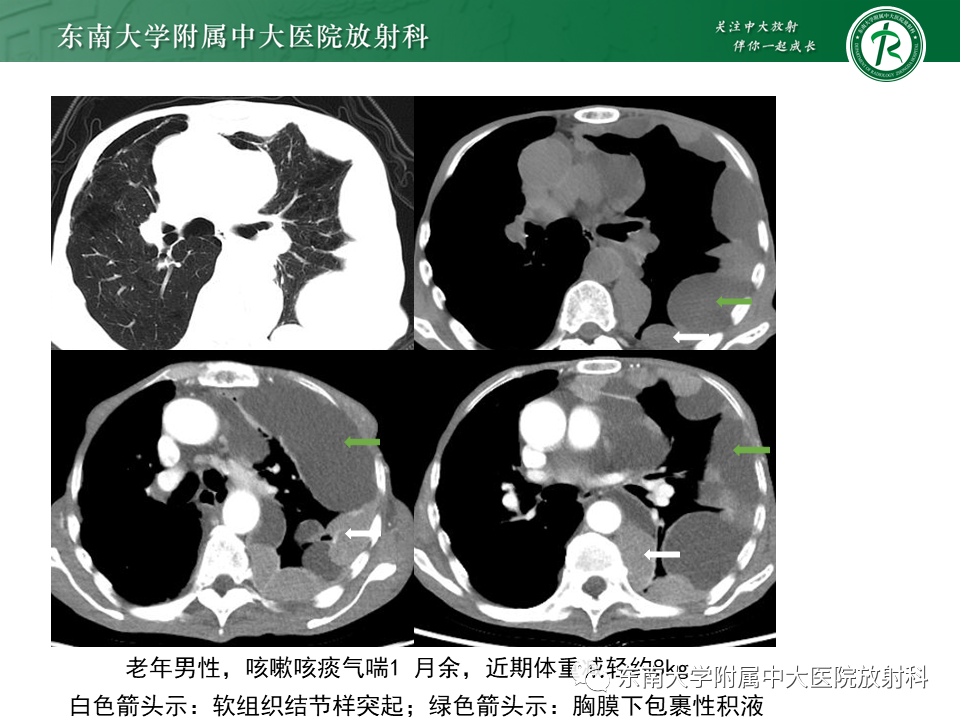 影像PPT - 【病例】胸膜孤立性纤维瘤1例CT影像-14