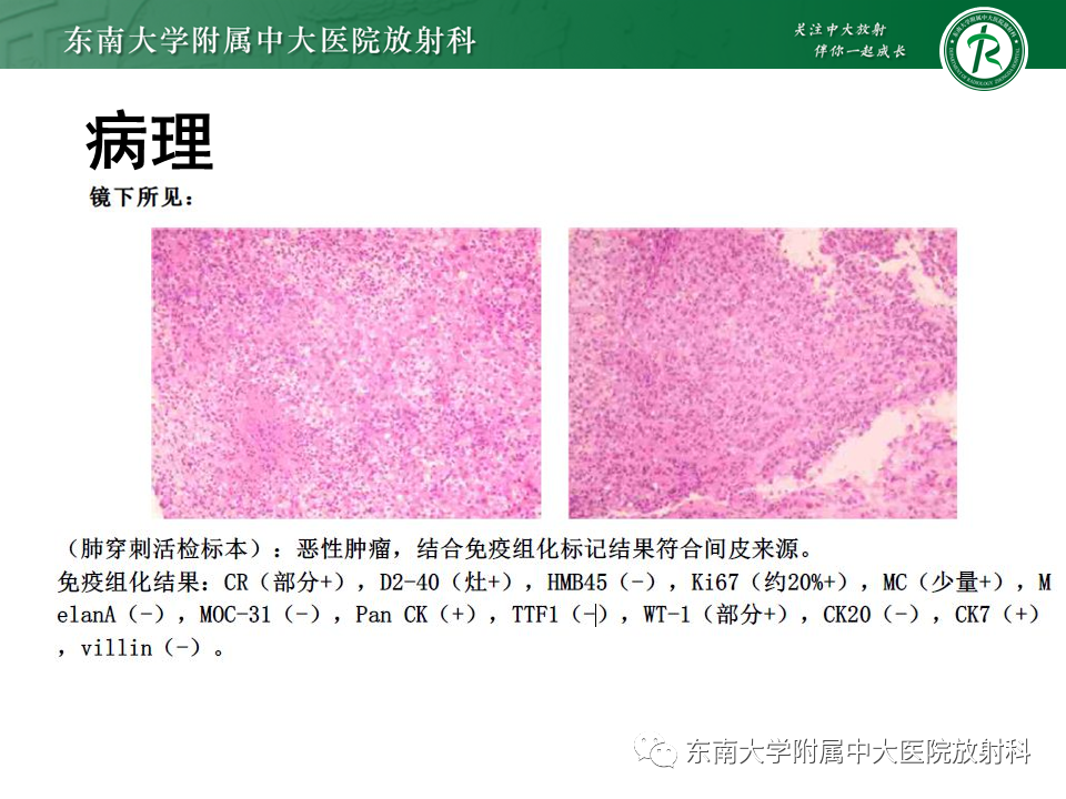 影像PPT - 【病例】胸膜孤立性纤维瘤1例CT影像-15