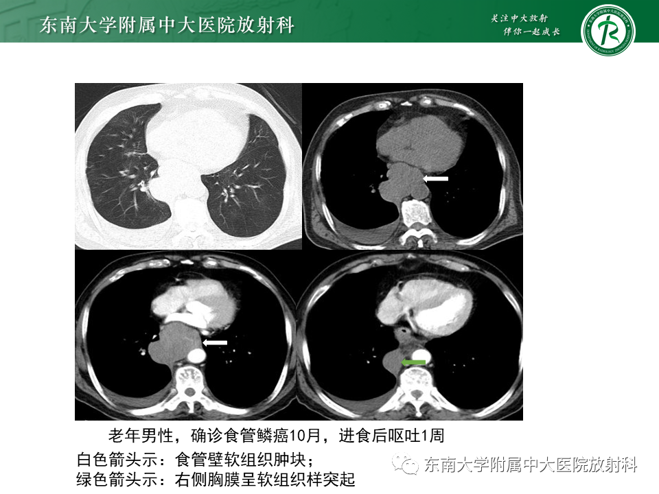 影像PPT - 【病例】胸膜孤立性纤维瘤1例CT影像-17
