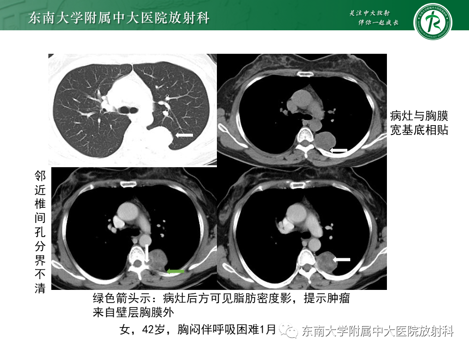 影像PPT - 【病例】胸膜孤立性纤维瘤1例CT影像-19