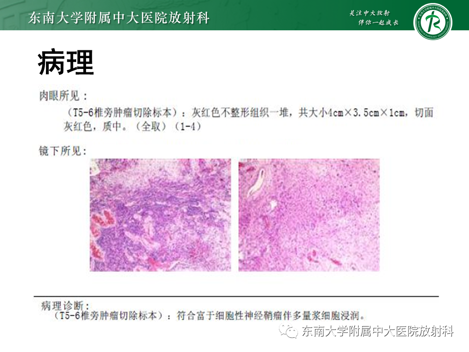 影像PPT - 【病例】胸膜孤立性纤维瘤1例CT影像-20