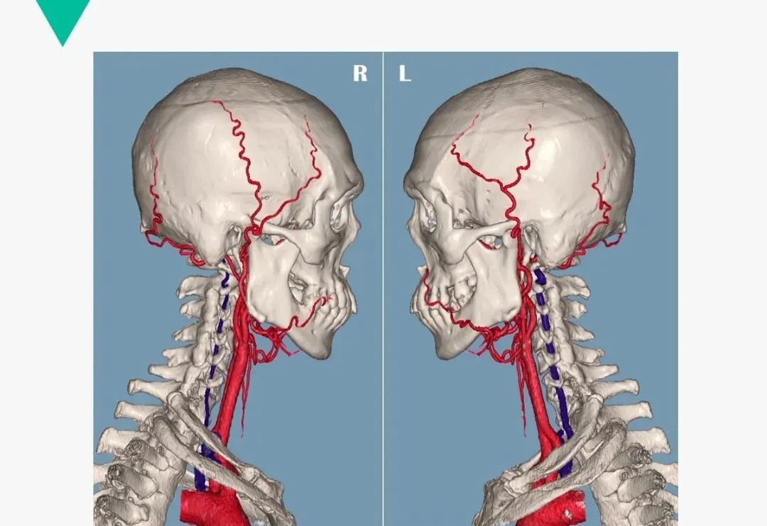 影像PPT - 【PPT】头颈血管解剖与分段—CTA重组图像示例-10