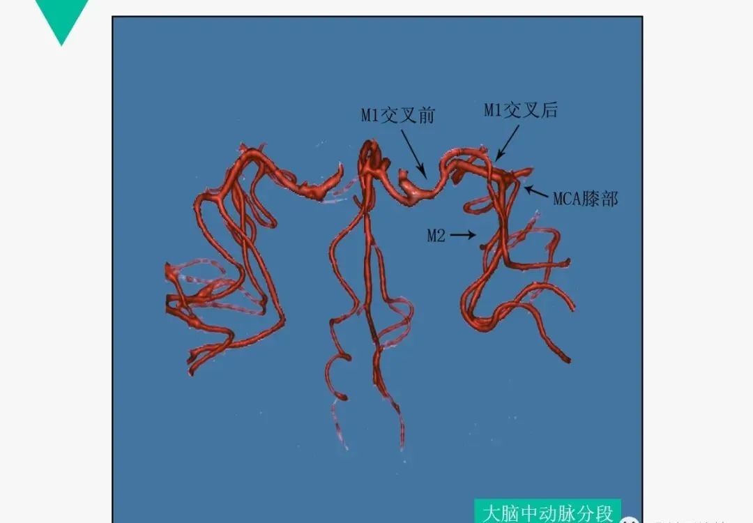 影像PPT - 【PPT】头颈血管解剖与分段—CTA重组图像示例-20