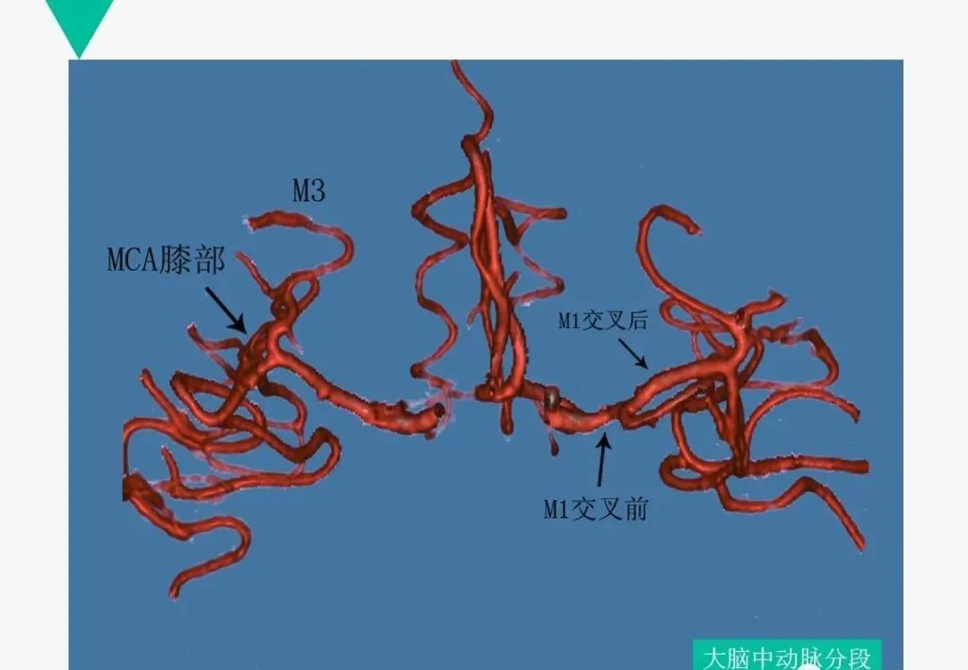 影像PPT - 【PPT】头颈血管解剖与分段—CTA重组图像示例-21