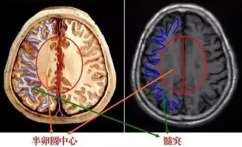 影像PPT - 放射冠与半卵圆中心的区别-2 影像PPT - 放射冠与半卵圆中心的区别-2