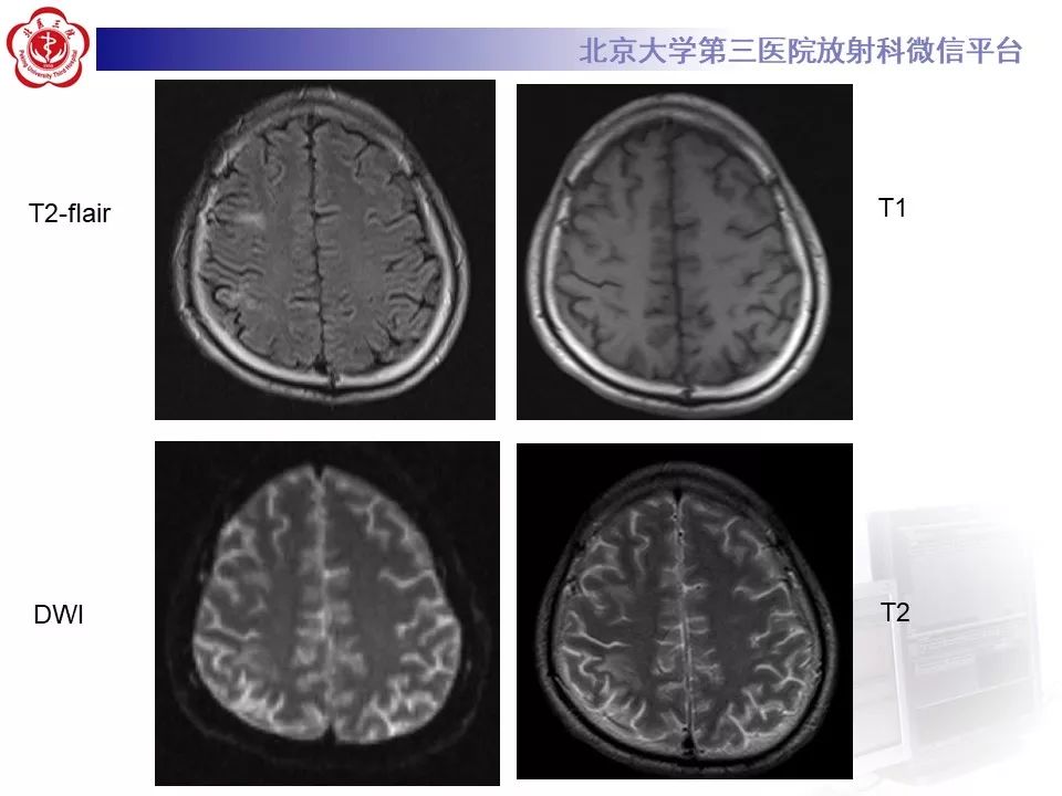 影像PPT - 【PPT】肾上腺脑白质营养不良（ALD）影像诊断-2