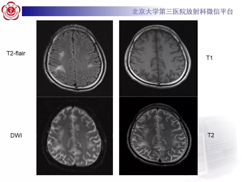 影像PPT - 【PPT】肾上腺脑白质营养不良（ALD）影像诊断-3