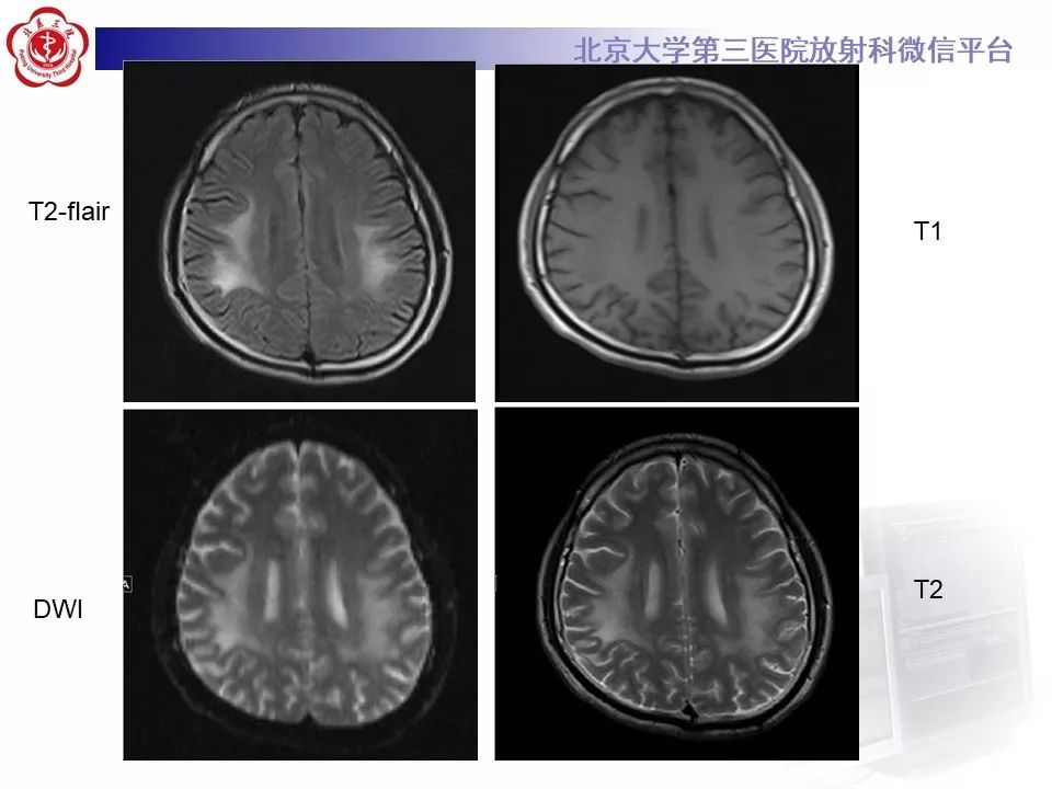 影像PPT - 【PPT】肾上腺脑白质营养不良（ALD）影像诊断-4