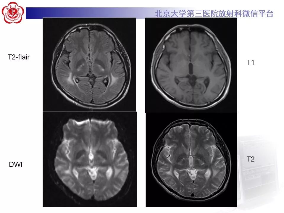 影像PPT - 【PPT】肾上腺脑白质营养不良（ALD）影像诊断-6