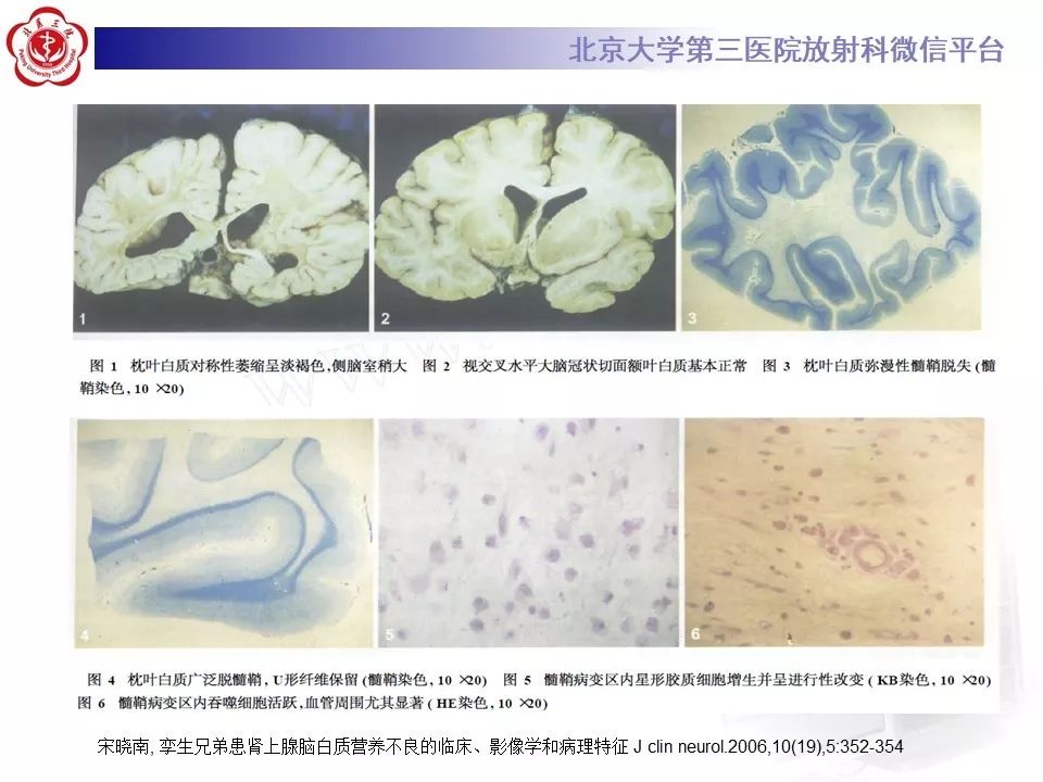 影像PPT - 【PPT】肾上腺脑白质营养不良（ALD）影像诊断-15